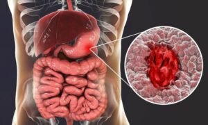 Ung thư dạ dày di căn buồng trứng: những điều bạn cần biết