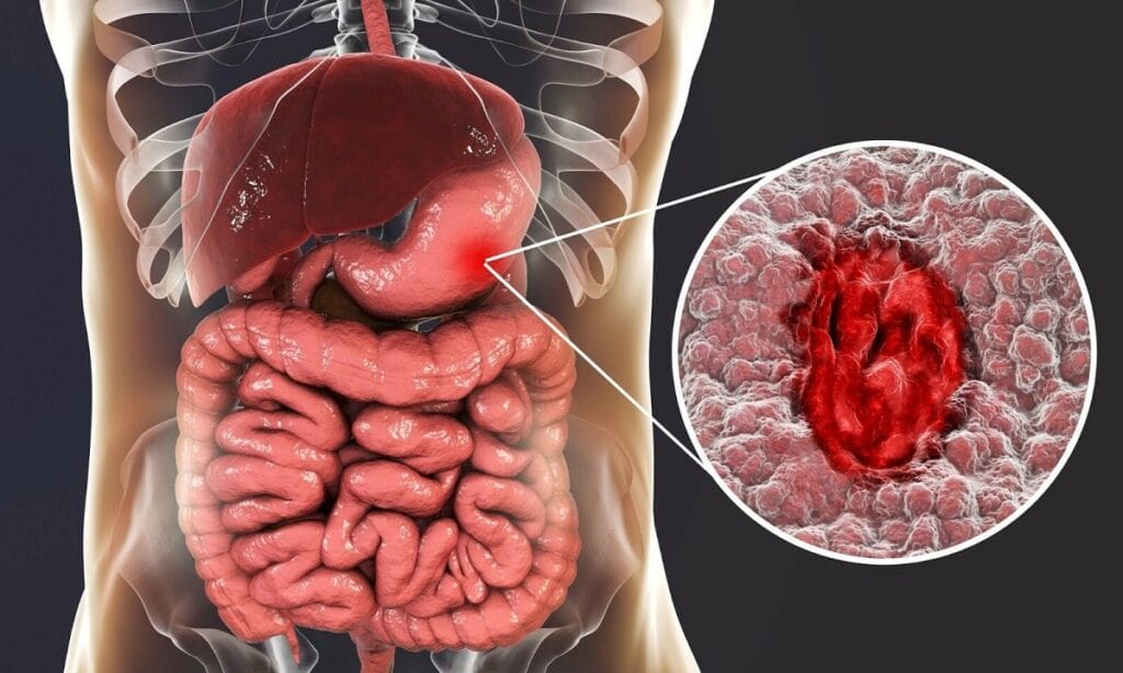 Ung thư dạ dày di căn buồng trứng: những điều bạn cần biết Ung thư dạ dày di căn buồng trứng: những điều bạn cần biết