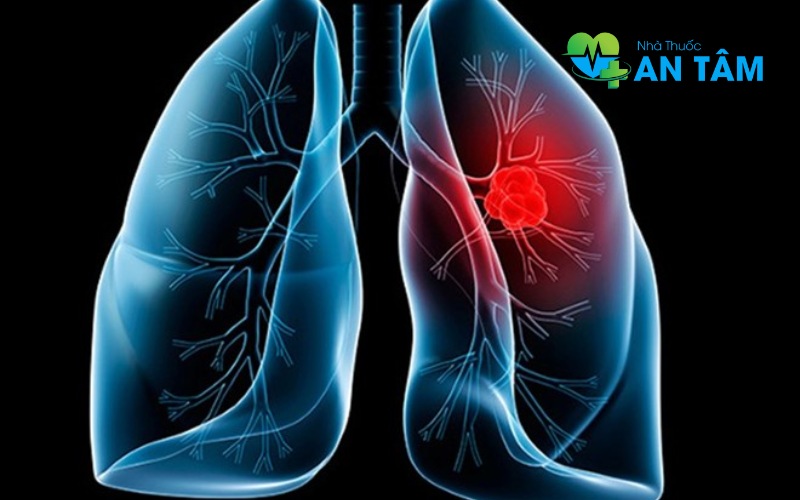 Ung thư vú di căn phổi là gì?