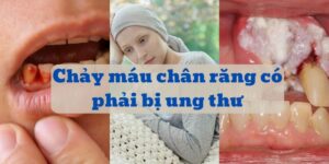 Chảy máu chân răng ung thư