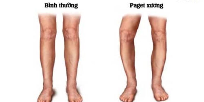 Bệnh Paget xương (Paget's Disease of Bone)