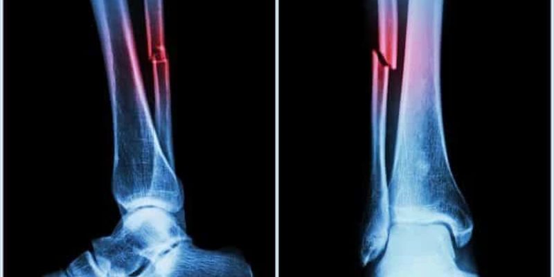 Điều trị bệnh Paget xương