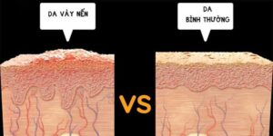 Vảy nến là gì?