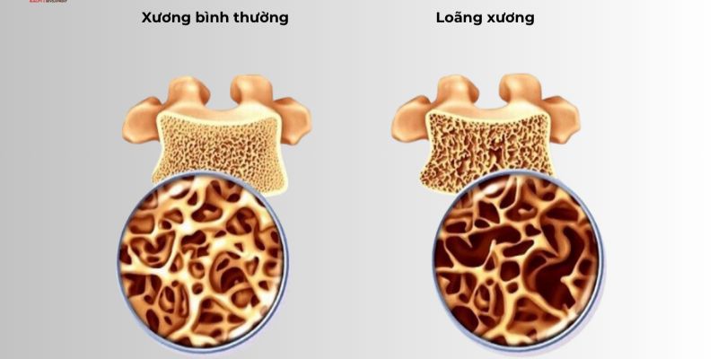 Phân loại các tình trạng loãng xương hiện nay