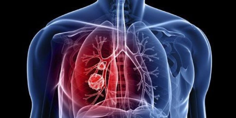 Triệu chứng của tăng huyết áp động mạch phổi