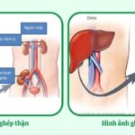 Tổng quan thải ghép nguyên nhân dấu hiệu và triệu chứng Thải ghép là gì?