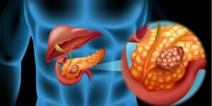 Thiểu năng tụy ngoại tiết