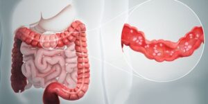 Viêm loét đại tràng: Những điều cần biết để bảo vệ đường ruột