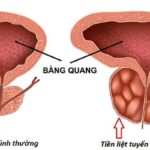 Phì Đại Tuyến Tiền Liệt
