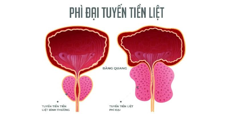 Phì đại tuyến tiền liệt nguy hiểm không? Tìm hiểu ngay! 5 Phì Đại Tuyến Tiền Liệt