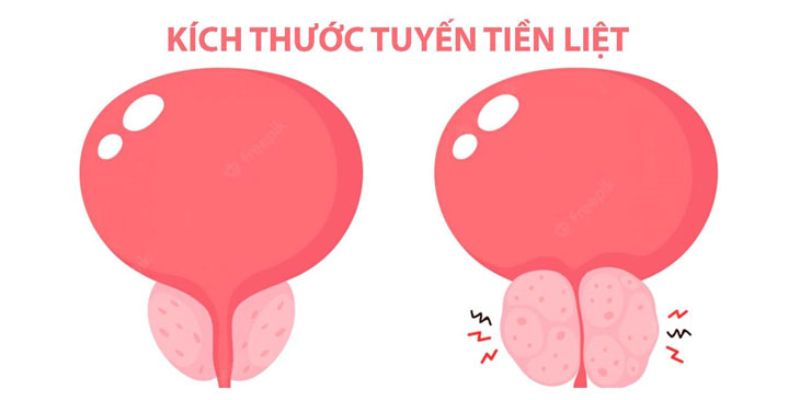 Phì đại tuyến tiền liệt nguy hiểm không? Tìm hiểu ngay! 7 Có nên phẫu thuật khi bị phì đại tuyến tiền liệt?
