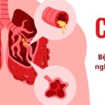 Tắc Nghẽn Phổi Mạn Tính (COPD)